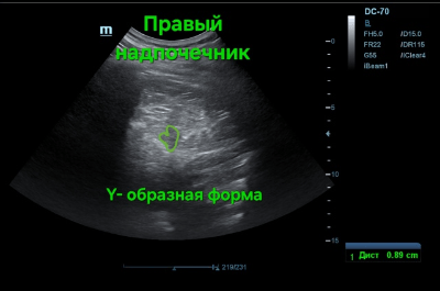 Правый надпочечник